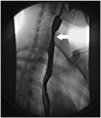 Eosinophilic Esophagitis Is an Underlying Cause for Gastrointestinal Concerns in Children